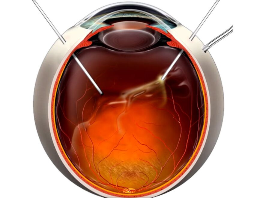 Vitrectomia - egy eljárás, amelyet az embereknek mutattak be a retina hámlasztásakor